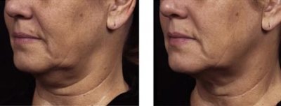 image neck-before-and-after-3-jpg