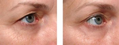 image thermage-eyes-before-and-after-2-jpg