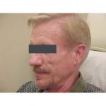 Lipoatrophy treatment: before Sculptra - left profile