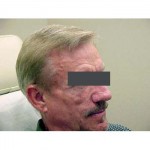 Lipoatrophy treatment: before Sculptra - right profile