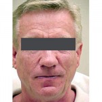 Lipoatrophy treatment: 12 months after Sculptra treatment - front view