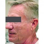 Lipoatrophy treatment: 12 months after Sculptra treatment - left view