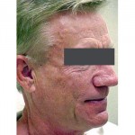 Lipoatrophy treatment: 12 months after Sculptra treatment - right view