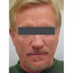 Lipoatrophy treatment: 2 years after Sculptra treatment -  front view