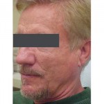Lipoatrophy treatment: 2 years after Sculptra treatment -  left view