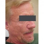 Lipoatrophy treatment: 2 years after Sculptra treatment - right view