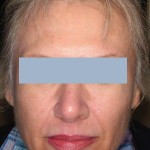 Patient after 1 Sculptra treatment