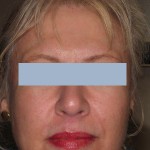 Patient after 2 Sculptra treatments