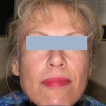 Patient before Sculptra treatment