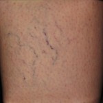Photo Before and After Asclera Treatment: Before Asclera