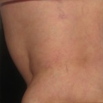 Photo Before and After Asclera Treatment: After Asclera