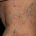 Photo Before and After Asclera Treatment: Before Asclera