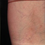 Photo Before and After Asclera Treatment: After Asclera