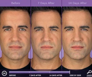 Botox: before and after photos - patient 5