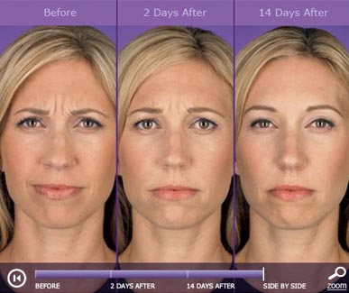 Botox: before and after photos and testimonials