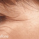 Belotero dermal filler - before and after photos of crows feet enhancement