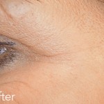 Belotero dermal filler - before and after photos of crows feet enhancement