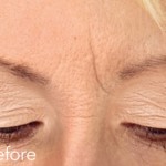 Belotero dermal filler - before and after photos of frown lines enhancement