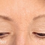 Belotero dermal filler - before and after photos of frown lines enhancement