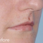Belotero dermal filler - before and after photos of lips enhancement