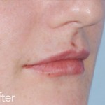 Belotero dermal filler - before and after photos of lips enhancement