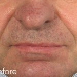 Belotero dermal filler - before and after photos of nasolabial folds enhancement