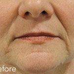 Belotero dermal filler - before and after photos of nasolabial folds enhancement