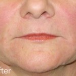 Belotero dermal filler - before and after photos of nasolabial folds enhancement