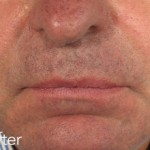 Belotero dermal filler - before and after photos of nasolabial folds enhancement
