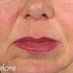 Belotero dermal filler - before and after photos of nasolabial folds enhancement