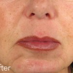 Belotero dermal filler - before and after photos of nasolabial folds enhancement