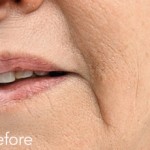 Belotero dermal filler - before and after photos of nasolabial folds enhancement