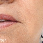 Belotero dermal filler - before and after photos of nasolabial folds enhancement