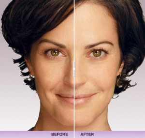 Before and After Juvederm: Jill