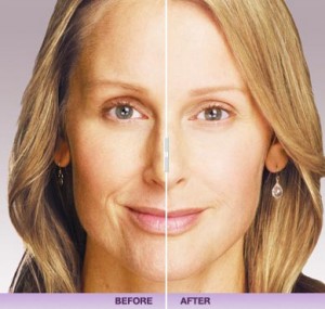 Before and After Juvederm: Lisa