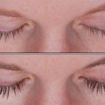 Eyelash Growth with Latisse: before and after photos