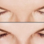 Eyelash Growth with Latisse: before and after photos