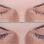 Eyelash Growth with Latisse: before and after photos