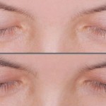 Eyelash Growth with Latisse: before and after photos