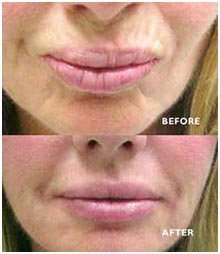 Lip Augmentation before and after photos
