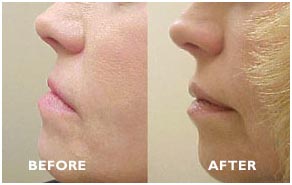 Lip Augmentation Before and After photos