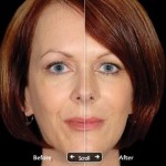 Restylane: before and after photos - Stacy