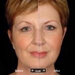 Restylane: before and after photos - Vicky