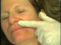 Dr. Mest demonstrates how to apply Sculptra - part 2