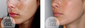 Skin Peel: Spot Peel home skin peel before and after photos - 1