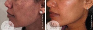 Skin Peel: Spot Peel home skin peel before and after photos - 4