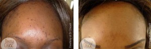 Skin Peel: Spot Peel home skin peel before and after photos - 5
