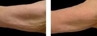 image thermage-body-before-and-after-2-jpg