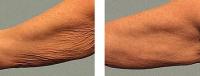 image thermage-body-before-and-after-3-jpg