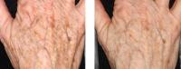 image thermage-body-before-and-after-5-jpg